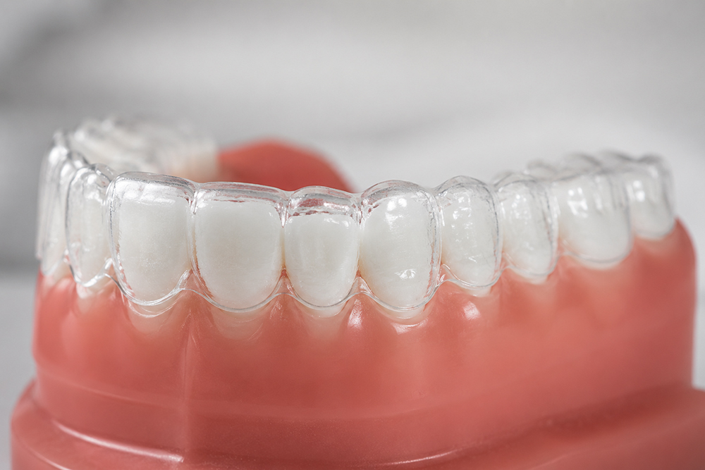 Aligner auf einem Zahnmodell